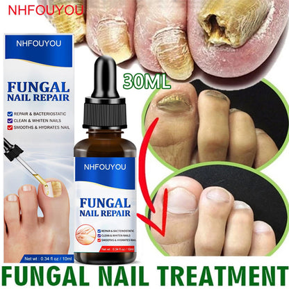 Aceite para tratamiento de uñas por hongos, esencia para reparación de pies