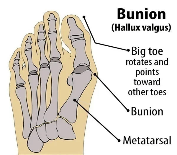 orrector de juanete de manga de férula Hallux Valgus