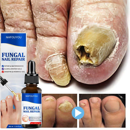 Aceite para tratamiento de uñas por hongos, esencia para reparación de pies