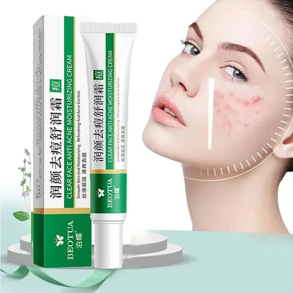 Crema facial efectiva para la eliminación del acné, Control de aceite, Gel de tratamiento anticicatrices y acné