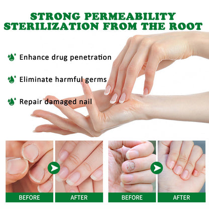 Aceite Esencial para tratamiento de hongos en las uñas